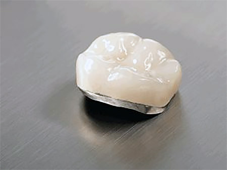 porcelain fused to metal buffalo ny
